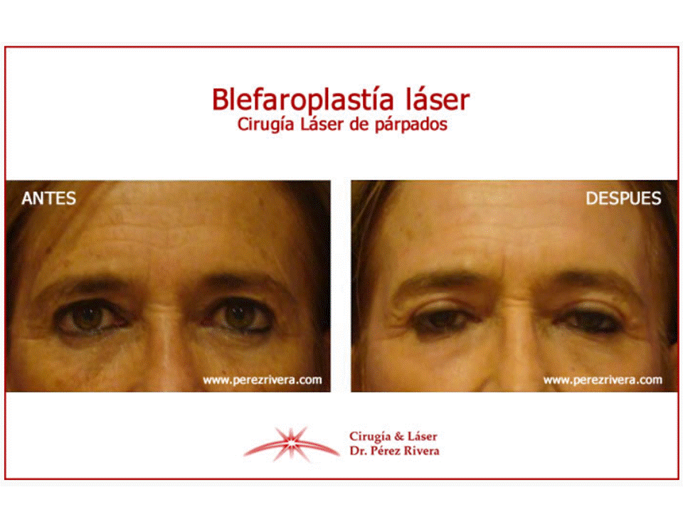 ¿Existe la Blefaroplastia Láser?